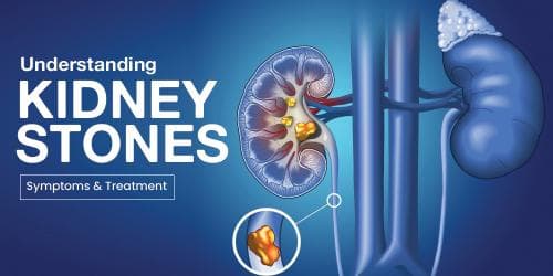 Understanding Kidney Stones – Symptoms & Treatment