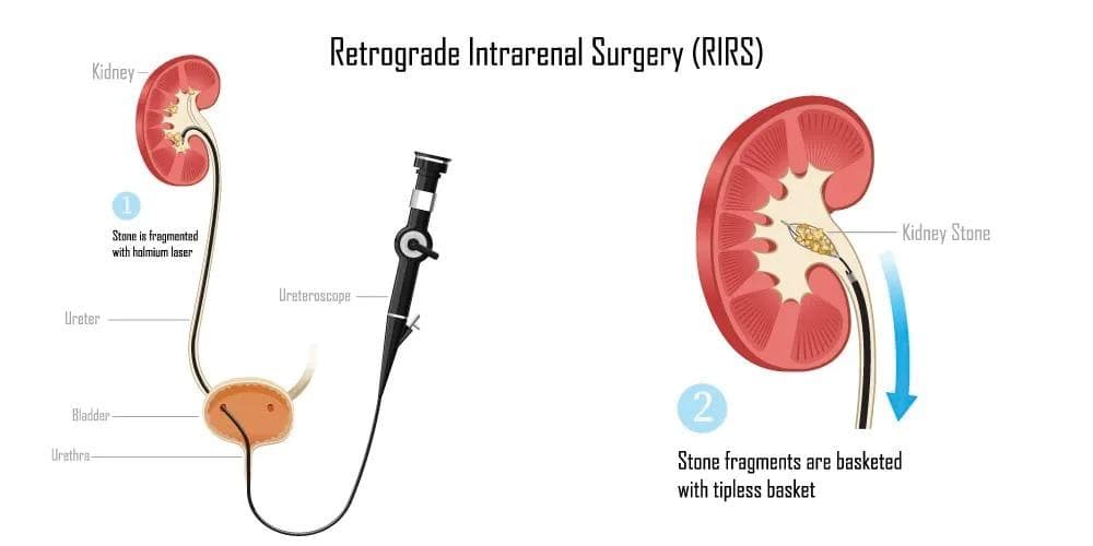 Advanced Kidney Stone Removal with Retrograde Intrarenal Surgery (RIRS)